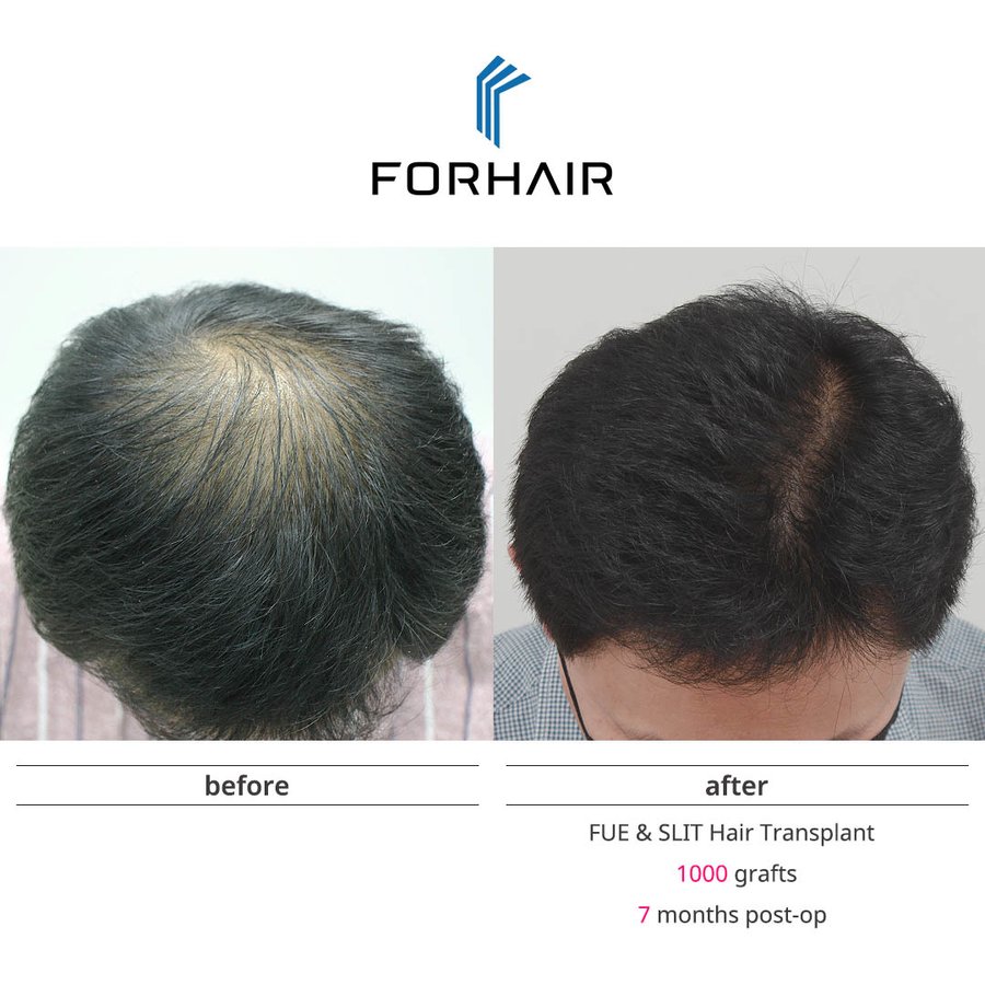 Hair Transplantation Fifth Edition（洋書） Hair Transplantation Fifth Edition（洋書） Hair