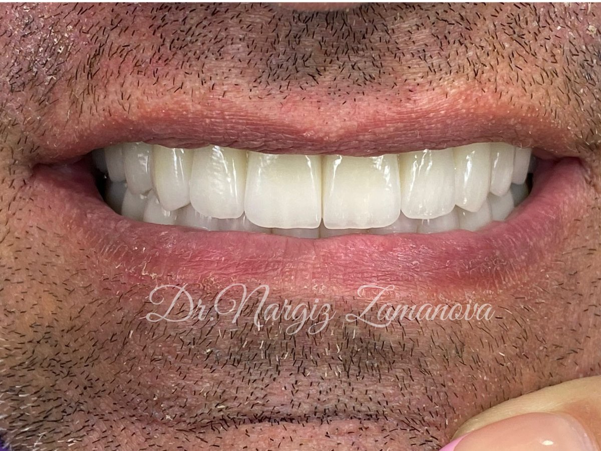 32 Beauty Billur Dent MMC - 32 Beauty Billur Dent MMC