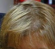 عيادة أبردين لاستعادة الشعر - Aberdeen Hair Restoration Clinic