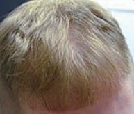 عيادة أبردين لاستعادة الشعر - Aberdeen Hair Restoration Clinic