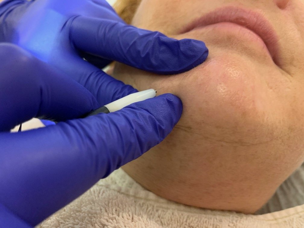 About Face Electrolysis - About Face Electrolysis