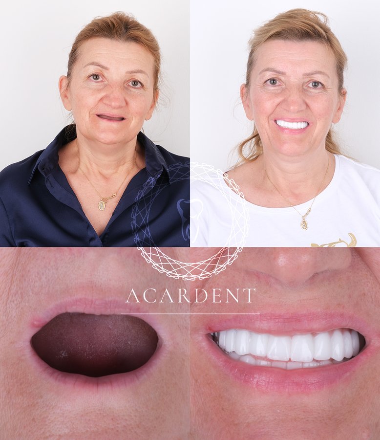 ACARDENT TURKEY - ACARDENT TURKEY