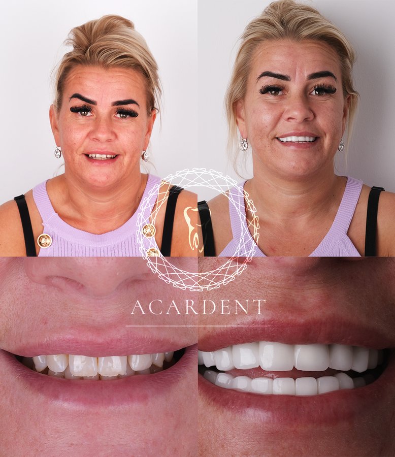 ACARDENT TURKEY - ACARDENT TURKEY