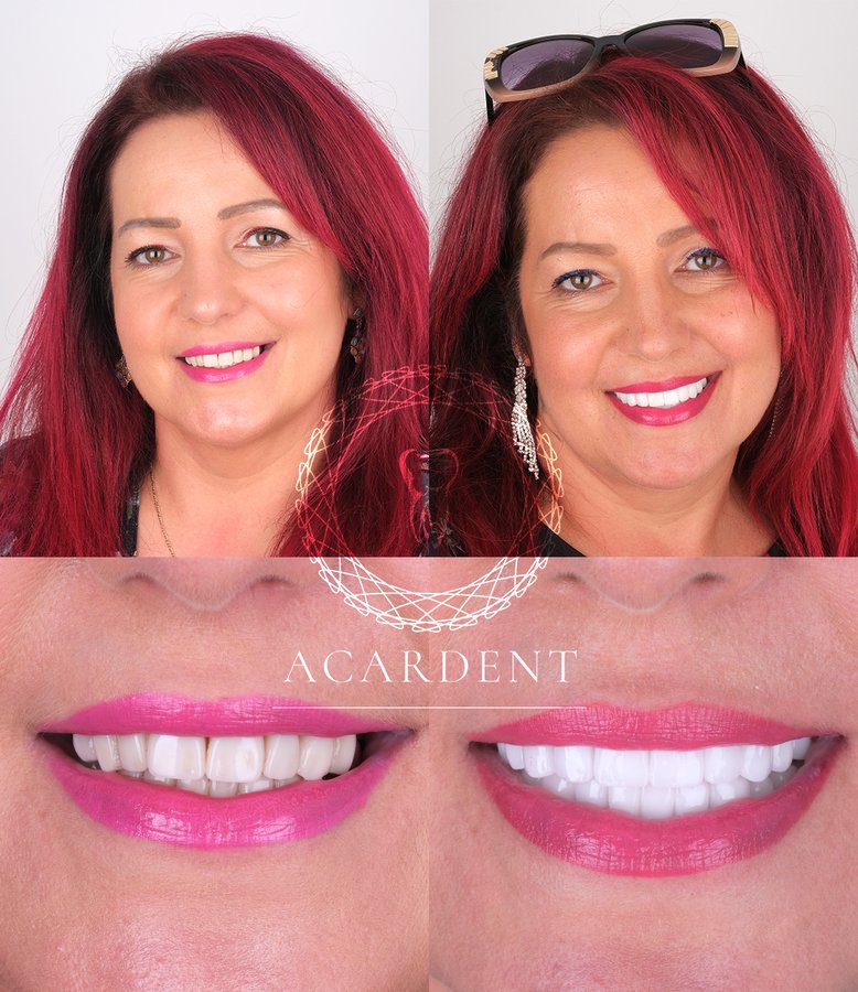 ACARDENT TURKEY - ACARDENT TURKEY