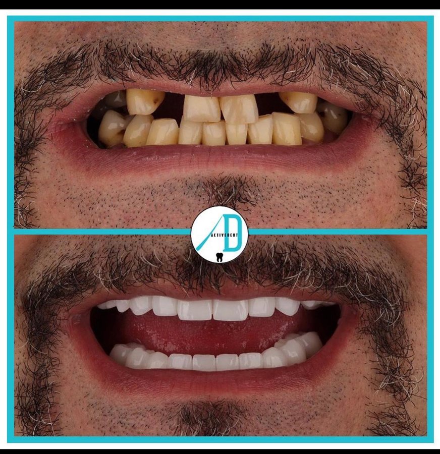 Active Dent - Active Dent