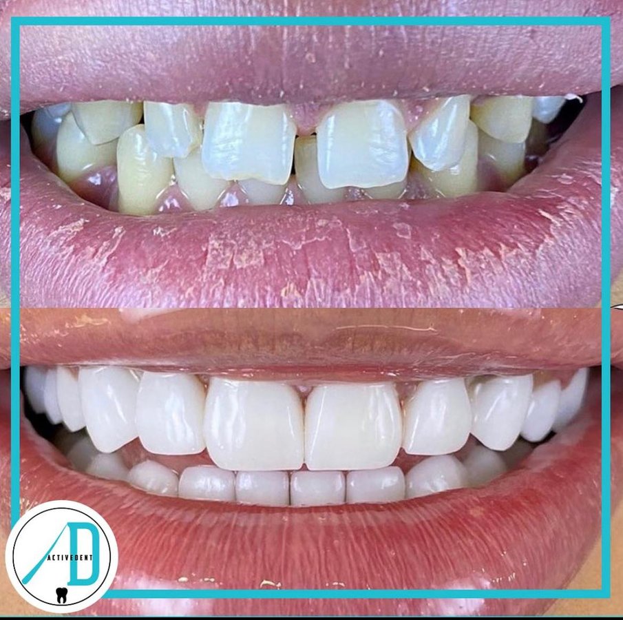 Active Dent - Active Dent