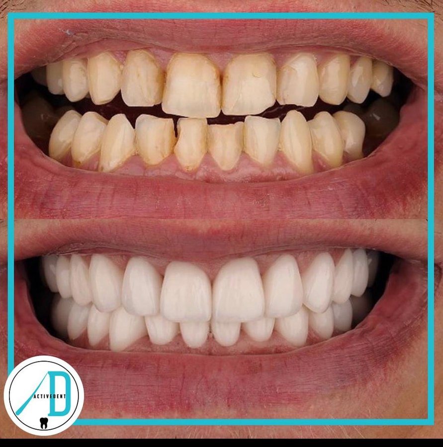 Active Dent - Active Dent