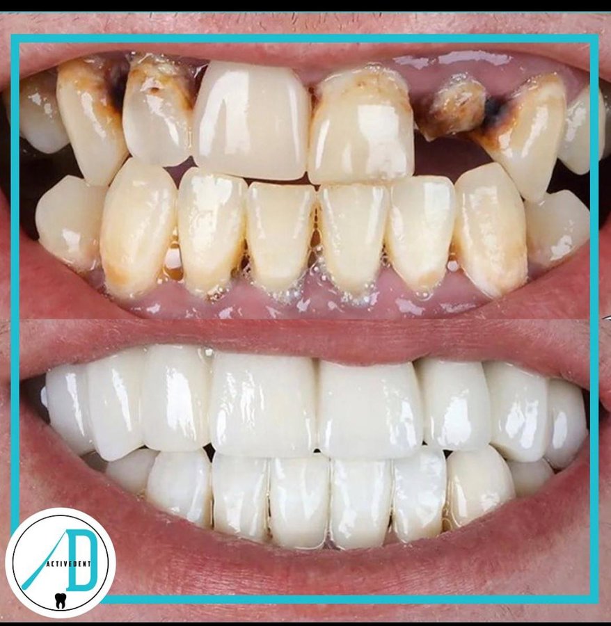 Active Dent - Active Dent