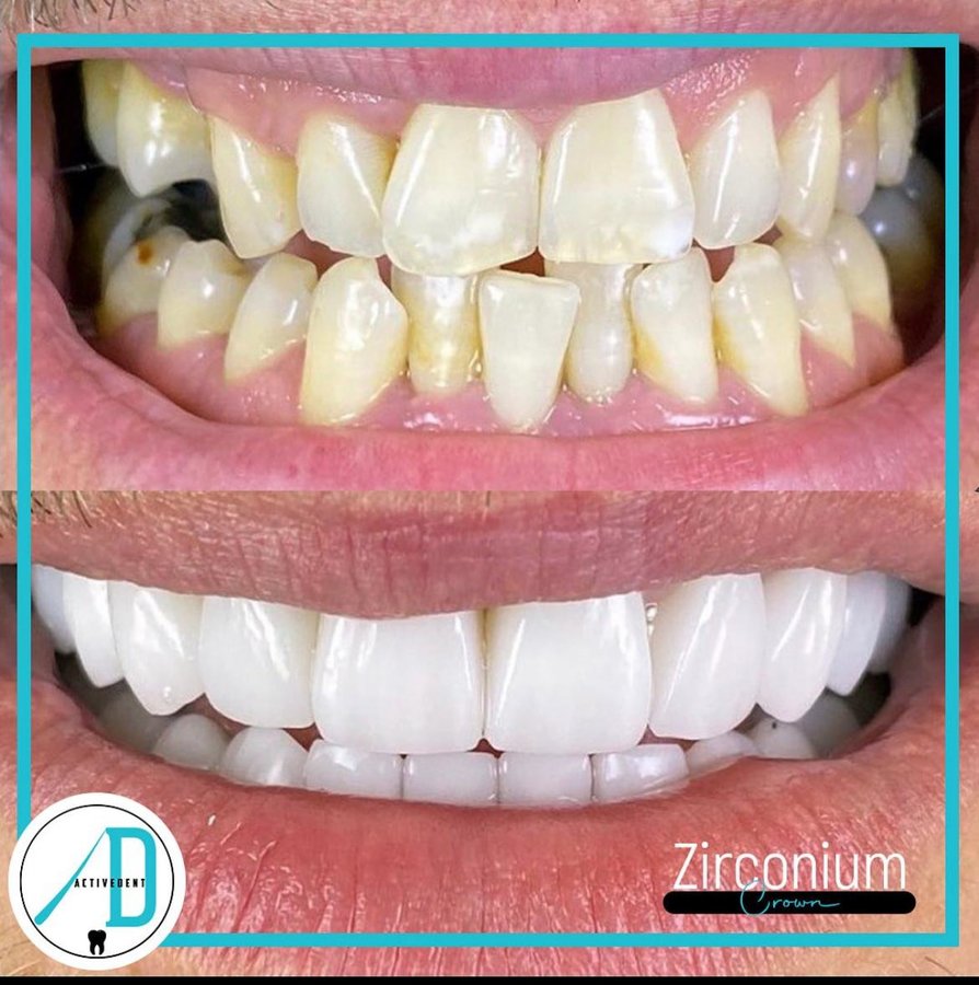 Active Dent - Active Dent