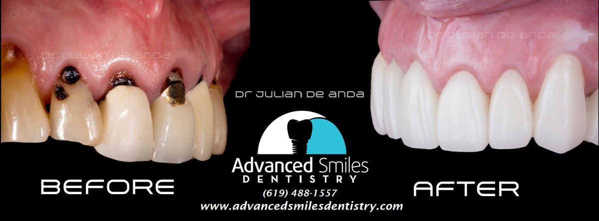 Advanced Smiles Dentistry Tijuana - Advanced Smiles Dentistry Tijuana