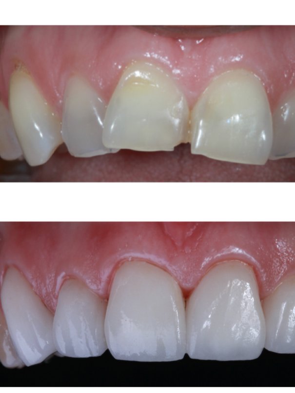 Advanced Smiles Dentistry Tijuana - Advanced Smiles Dentistry Tijuana