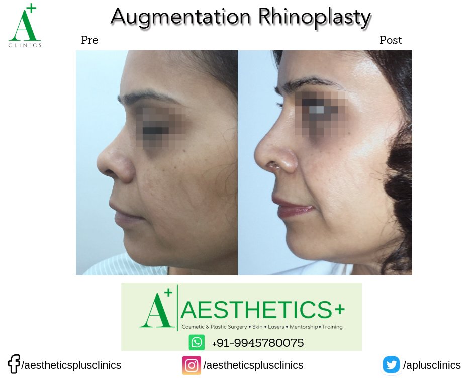 Aesthetic Plus Cosmetic Surgery Clinic - Bangalore Central - Aesthetic Plus Cosmetic Surgery Clinic - Bangalore Central