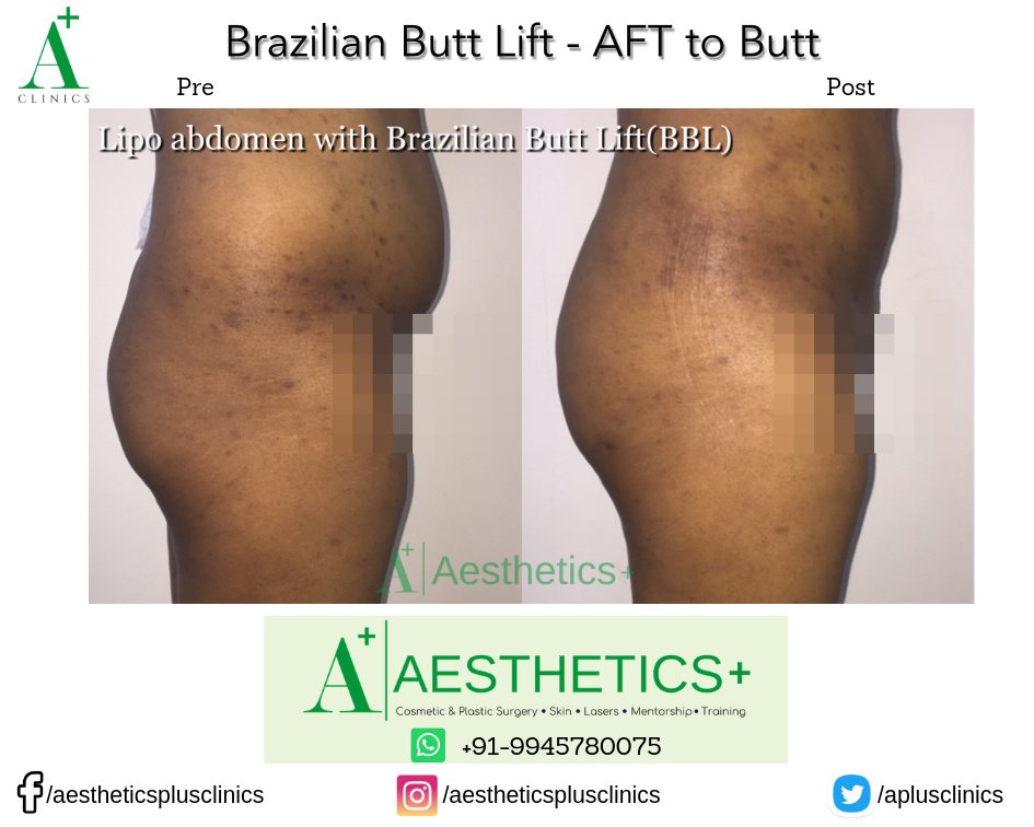 Aesthetic Plus Cosmetic Surgery Clinic - Bangalore Central - Aesthetic Plus Cosmetic Surgery Clinic - Bangalore Central