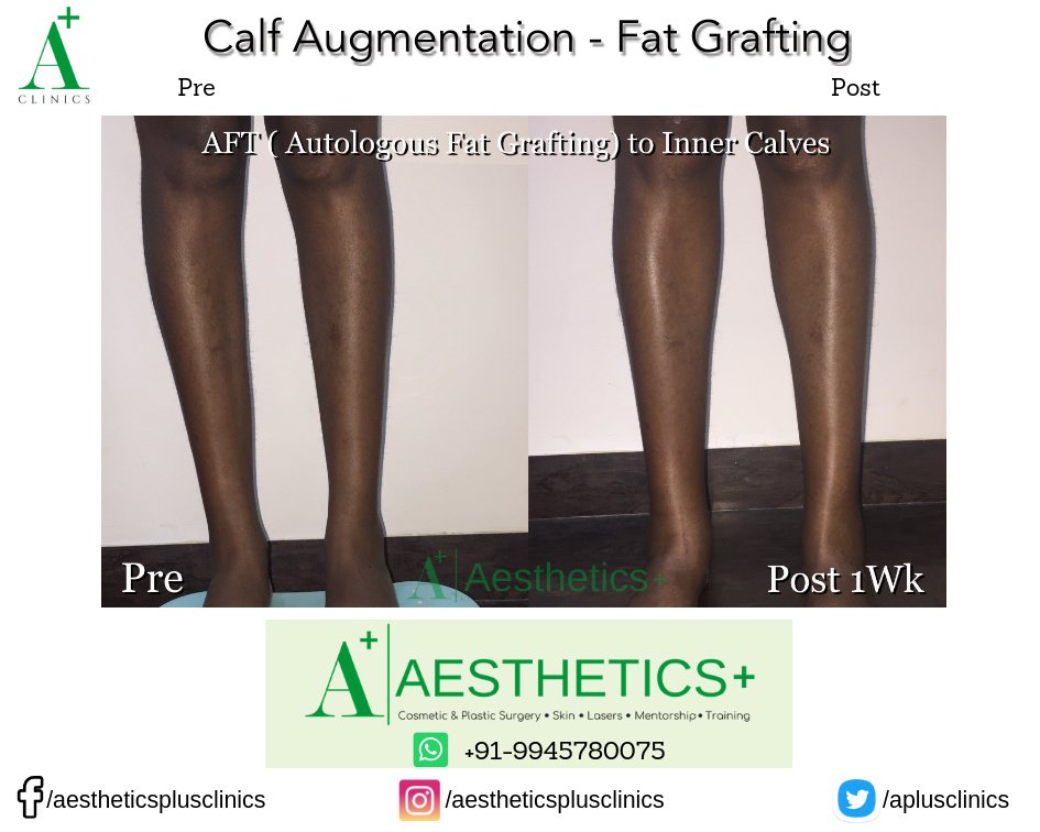 Aesthetic Plus Cosmetic Surgery Clinic - Bangalore Central - Aesthetic Plus Cosmetic Surgery Clinic - Bangalore Central