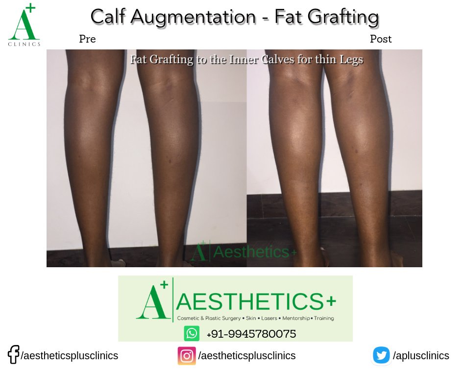 Aesthetic Plus Cosmetic Surgery Clinic - Bangalore Central - Aesthetic Plus Cosmetic Surgery Clinic - Bangalore Central