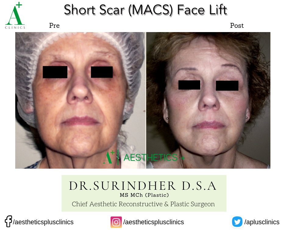 Aesthetic Plus Cosmetic Surgery Clinic - Bangalore Central - Aesthetic Plus Cosmetic Surgery Clinic - Bangalore Central