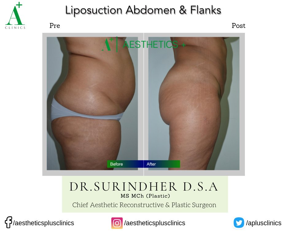 Aesthetic Plus Cosmetic Surgery Clinic - Bangalore Central - Aesthetic Plus Cosmetic Surgery Clinic - Bangalore Central