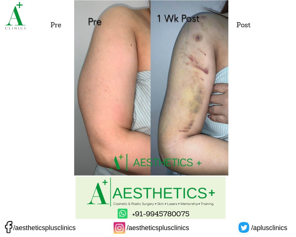 Aesthetic Plus Cosmetic Surgery Clinic - Bangalore Central - Aesthetic Plus Cosmetic Surgery Clinic - Bangalore Central