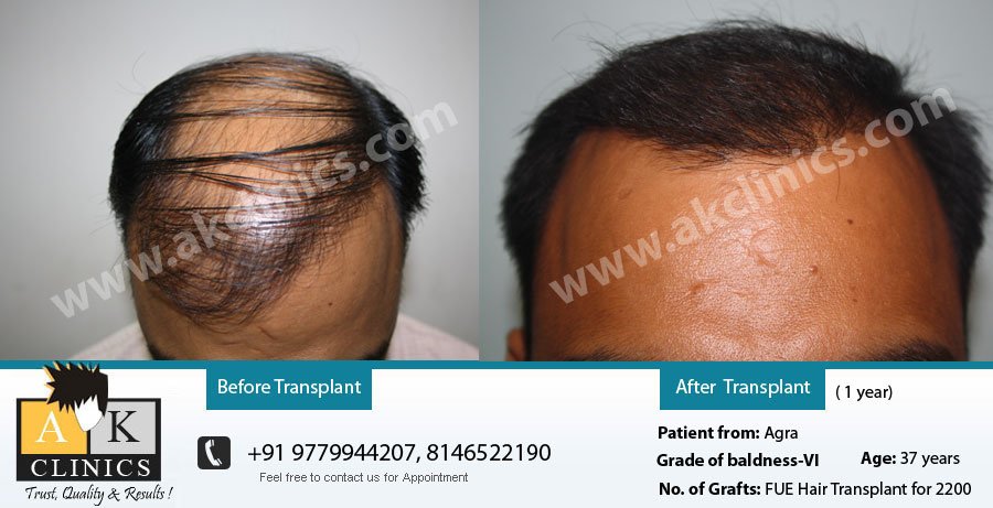 AK Clinics Pvt. Ltd Centre for Hair Transplant - Bangalore - AK Clinics Pvt. Ltd Centre for Hair Transplant - Bangalore
