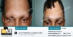 AK Clinics Pvt. Ltd Centre for Hair Transplant - Bangalore - AK Clinics Pvt. Ltd Centre for Hair Transplant - Bangalore