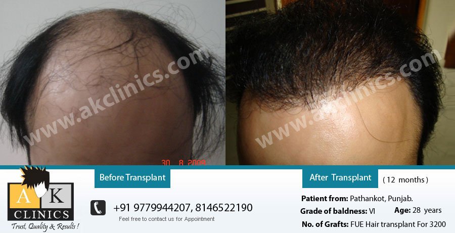 AK Clinics Pvt. Ltd Centre for Hair Transplant - Bangalore - AK Clinics Pvt. Ltd Centre for Hair Transplant - Bangalore