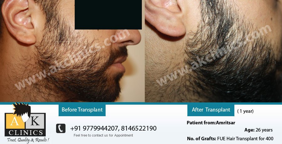 AK Clinics Pvt. Ltd Centre for Hair Transplant - Bangalore - AK Clinics Pvt. Ltd Centre for Hair Transplant - Bangalore