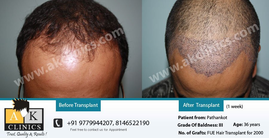 AK Clinics Pvt. Ltd Centre for Hair Transplant - Bangalore - AK Clinics Pvt. Ltd Centre for Hair Transplant - Bangalore
