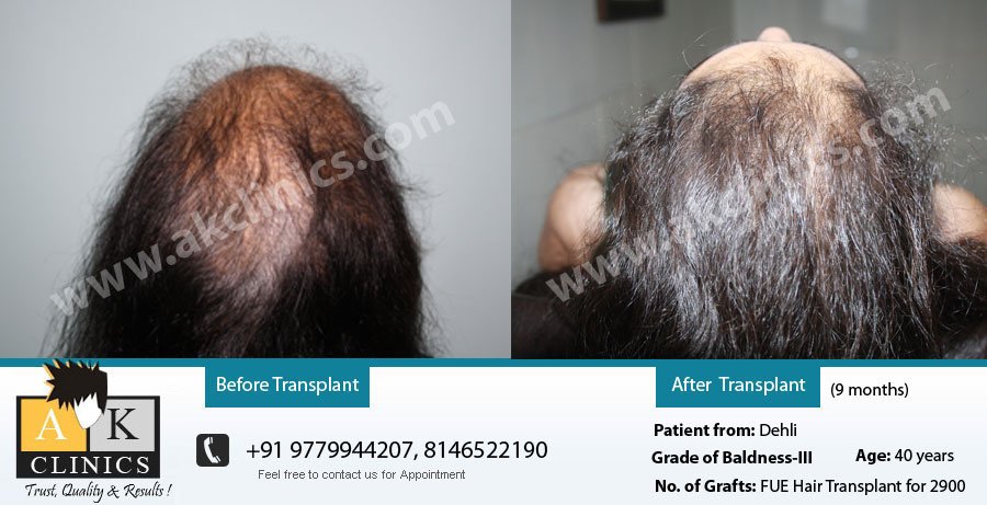 AK Clinics Pvt. Ltd Centre for Hair Transplant - Bangalore - AK Clinics Pvt. Ltd Centre for Hair Transplant - Bangalore