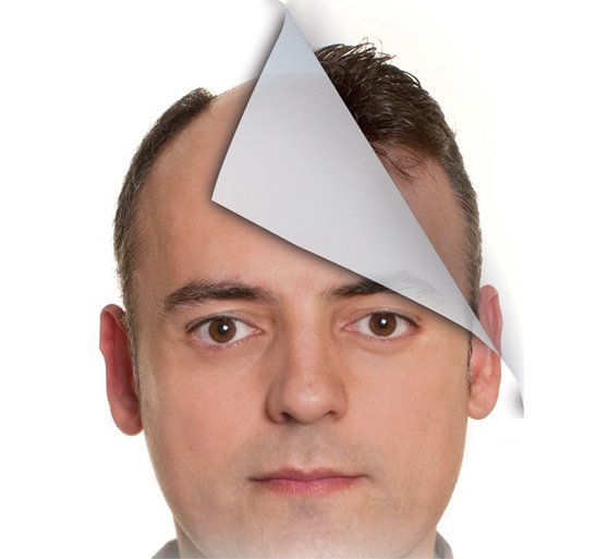 AK Clinics Pvt. Ltd Centre for Hair Transplant - Bangalore - AK Clinics Pvt. Ltd Centre for Hair Transplant - Bangalore