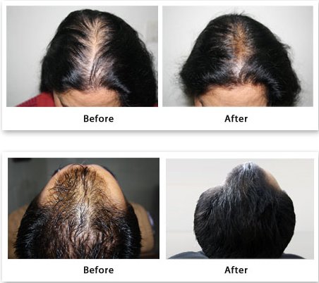 AK Clinics Pvt. Ltd Centre for Hair Transplant - Bangalore - AK Clinics Pvt. Ltd Centre for Hair Transplant - Bangalore
