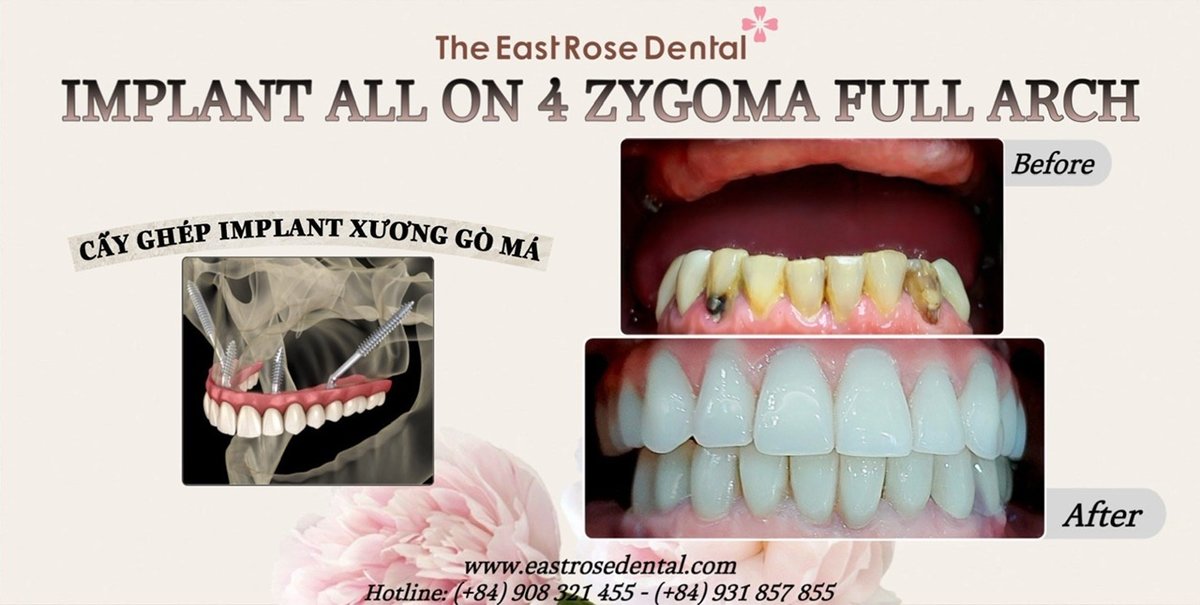 All On 4 Vietnam - The East Rose Dental - All On 4 Vietnam - The East Rose Dental