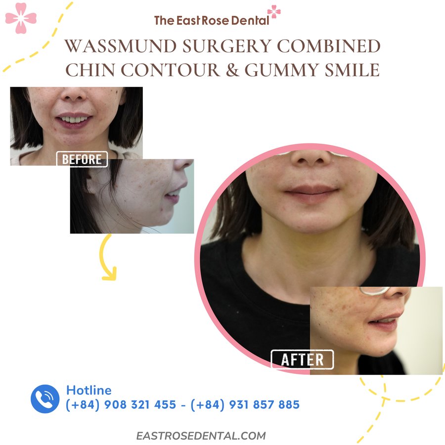 All On 4 Vietnam - The East Rose Dental - All On 4 Vietnam - The East Rose Dental