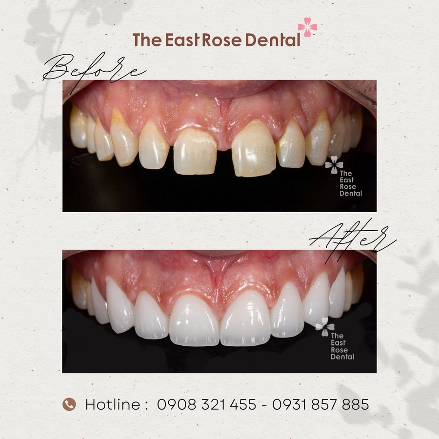 All On 4 Vietnam - The East Rose Dental - All On 4 Vietnam - The East Rose Dental