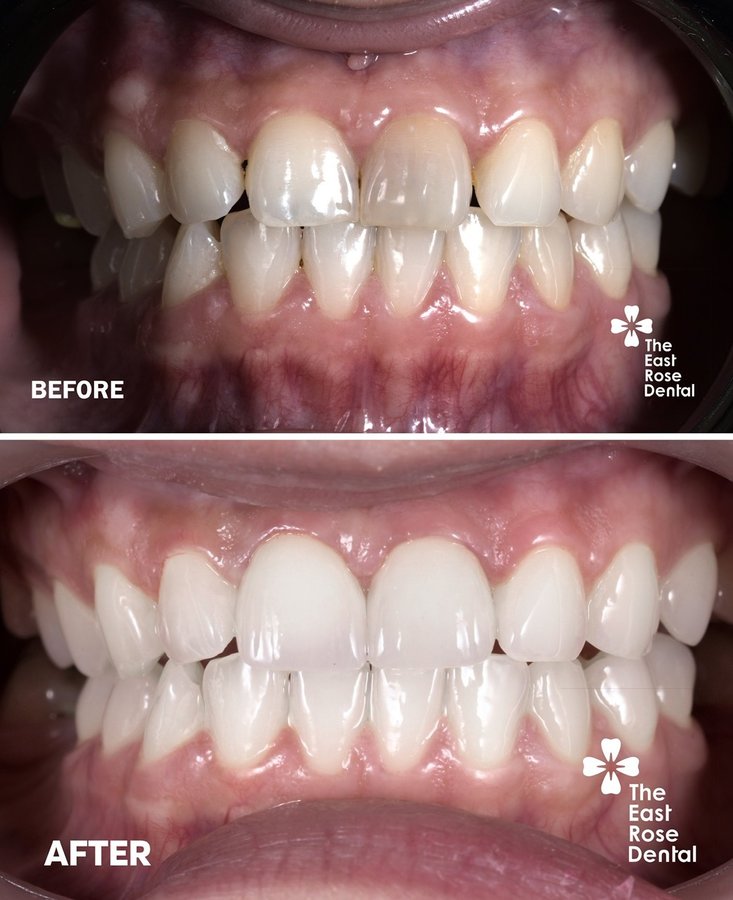 All On 4 Vietnam - The East Rose Dental - All On 4 Vietnam - The East Rose Dental