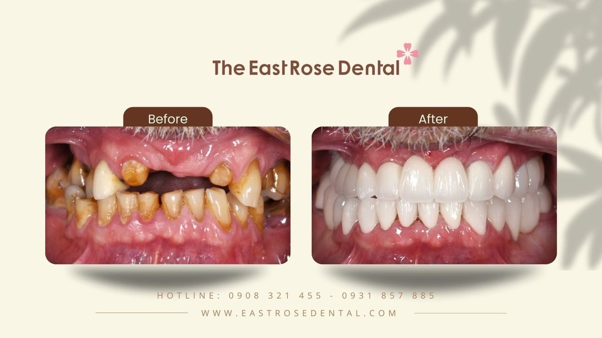 All On 4 Vietnam - The East Rose Dental - All On 4 Vietnam - The East Rose Dental