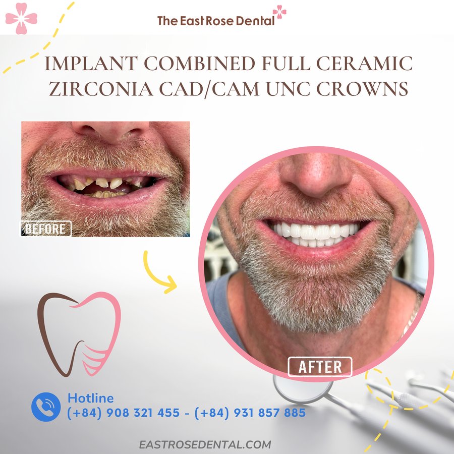 All On 4 Vietnam - The East Rose Dental - All On 4 Vietnam - The East Rose Dental