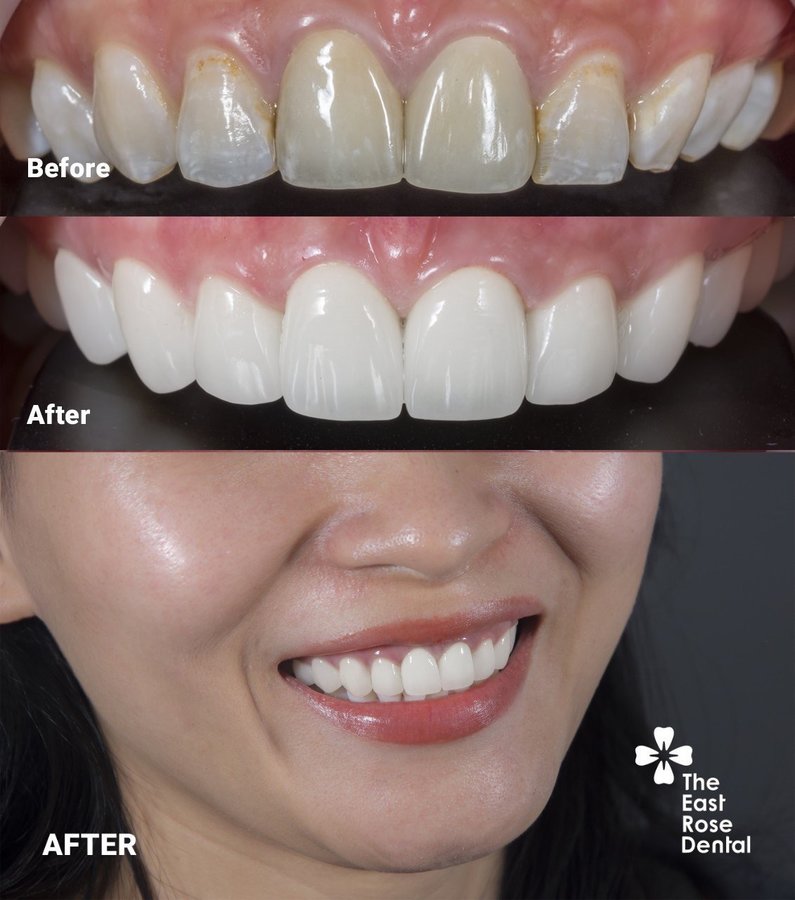 All On 4 Vietnam - The East Rose Dental - All On 4 Vietnam - The East Rose Dental