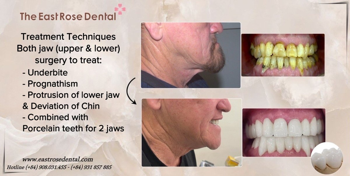 All On 4 Vietnam - The East Rose Dental - All On 4 Vietnam - The East Rose Dental