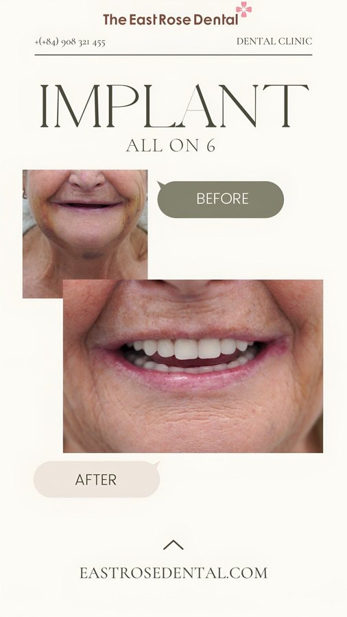 All On 4 Vietnam - The East Rose Dental - All On 4 Vietnam - The East Rose Dental