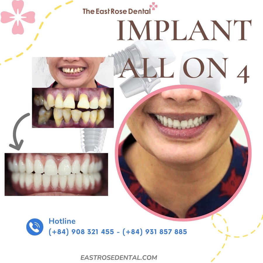 All On 4 Vietnam - The East Rose Dental - All On 4 Vietnam - The East Rose Dental