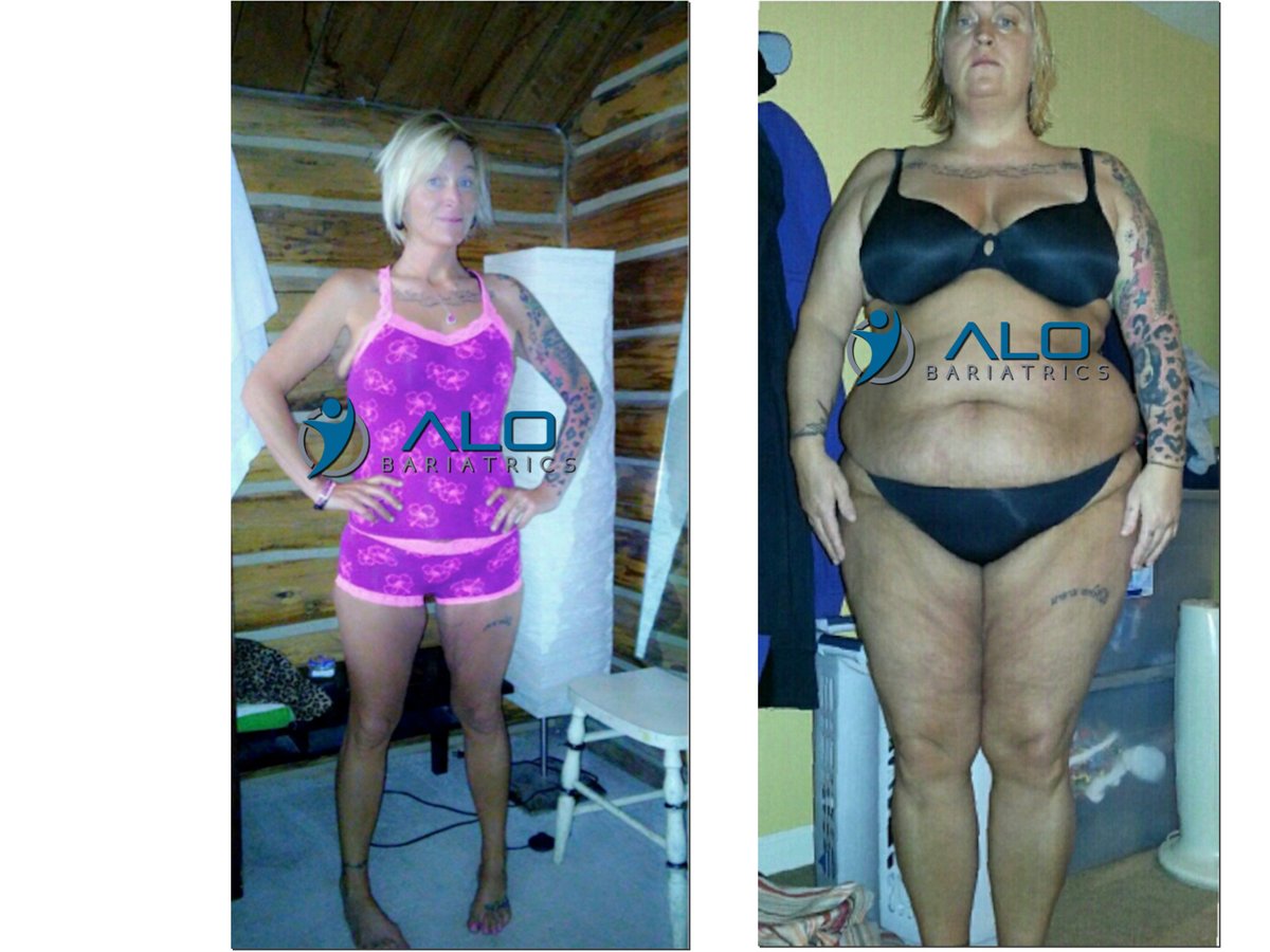 ALO Bariatrics - ALO Bariatrics