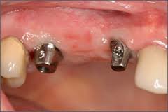 Alpha Dental Implant Center - Alpha Dental Implant Center