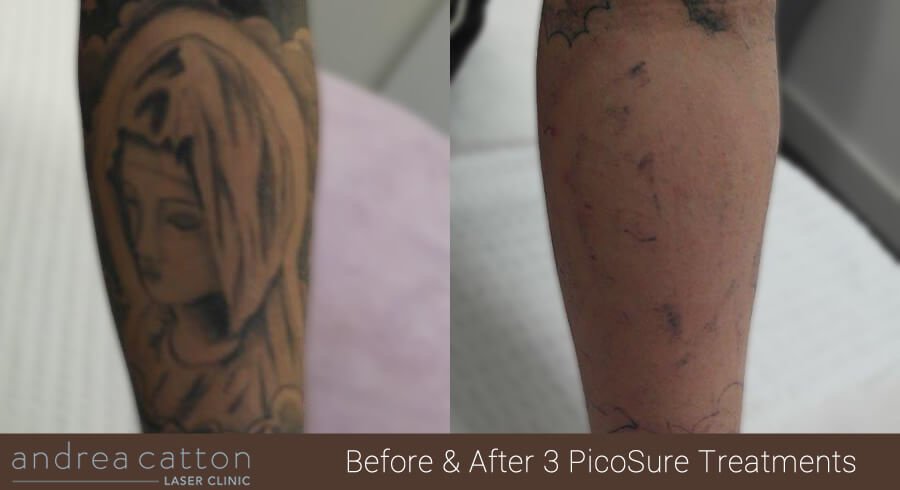 Andrea Catton Laser Clinic - Andrea Catton Laser Clinic