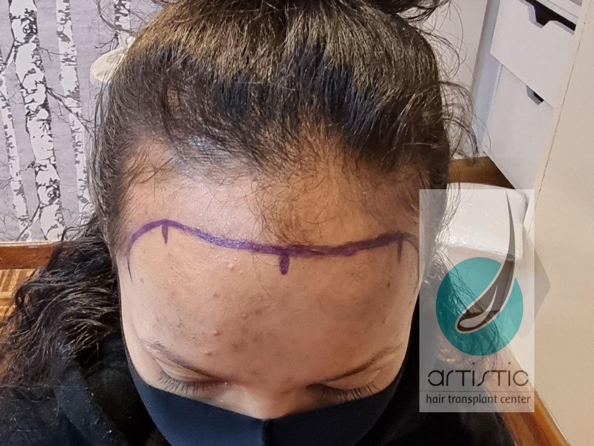 Artistic Hair Transplant Centre - Artistic Hair Transplant Centre