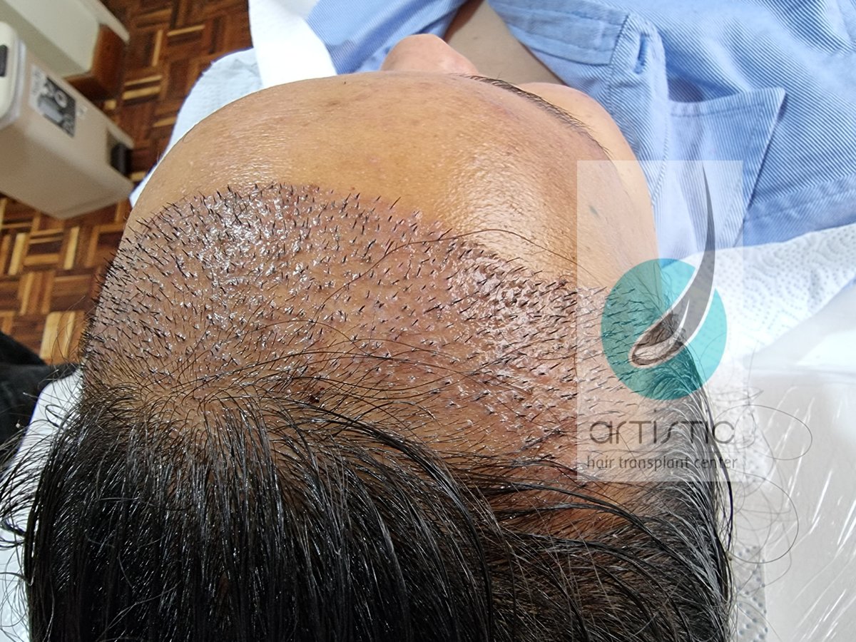 Artistic Hair Transplant Centre - Artistic Hair Transplant Centre