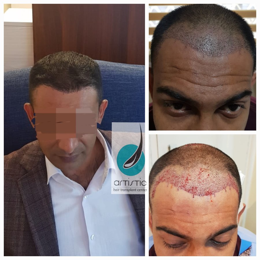 Artistic Hair Transplant Centre - Artistic Hair Transplant Centre