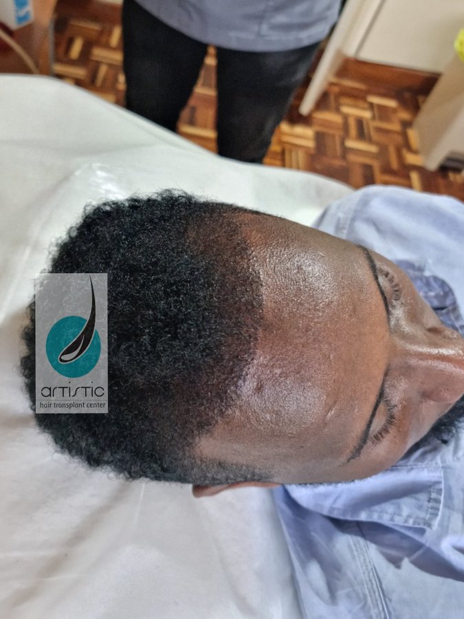 Artistic Hair Transplant Centre - Artistic Hair Transplant Centre