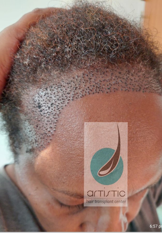 Artistic Hair Transplant Centre - Artistic Hair Transplant Centre