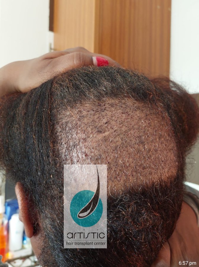 Artistic Hair Transplant Centre - Artistic Hair Transplant Centre