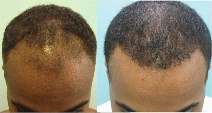 Artistic Hair Transplant Centre - Artistic Hair Transplant Centre